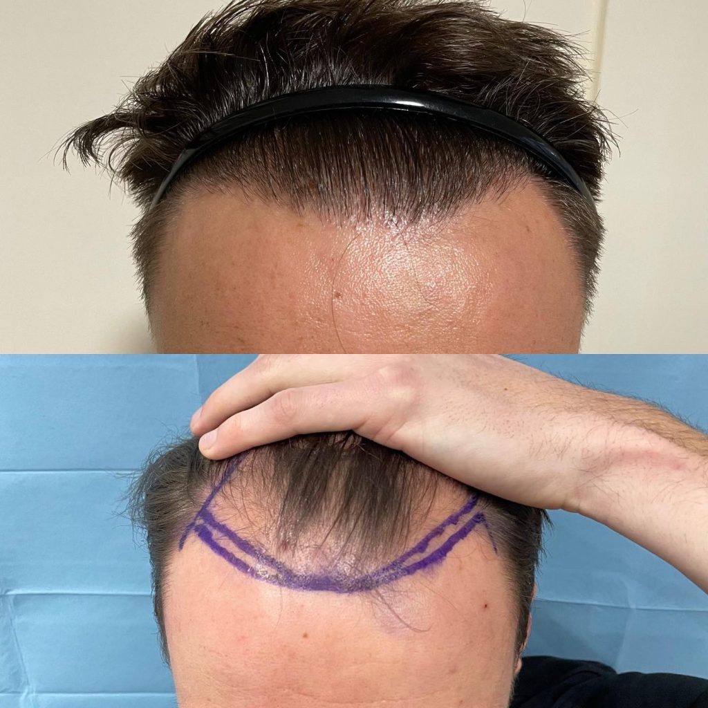 Why is a Hair Transplant Necessary?