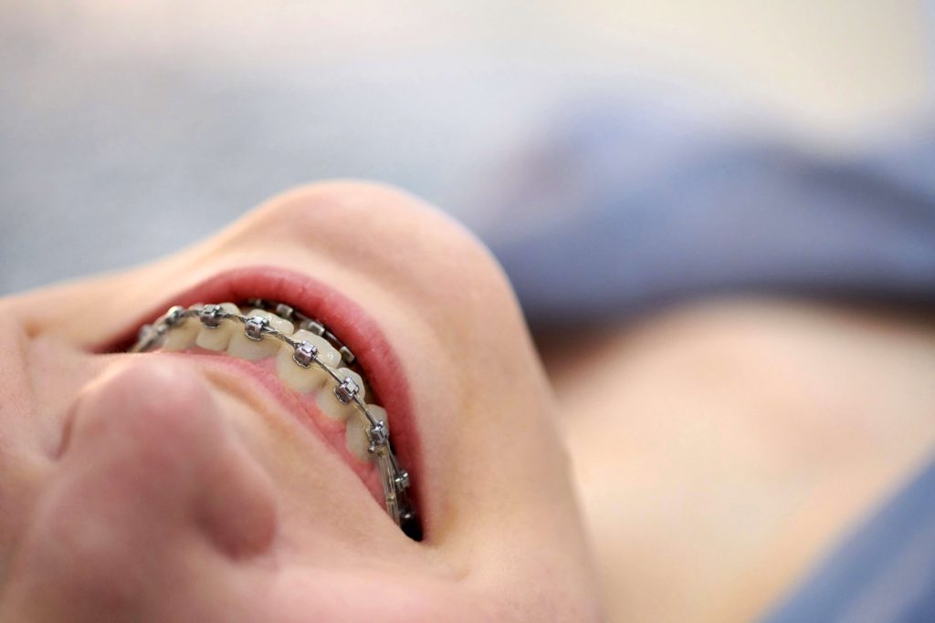 How Clear Braces Are Better Than Any Other?