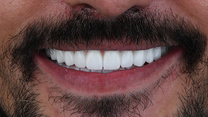 Perfect Smile: Your Comprehensive Guide to Transformative Veneers in Turkey
