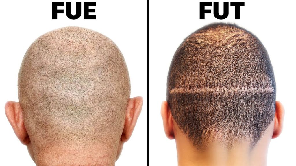 FUE VS FUT: Which Hair Transplant is Best for You?  
