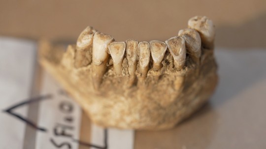 Teeth found at the Cardiff cemetery site are unusually worn