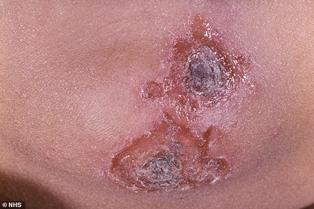 Impetigo is a very contagious skin infection, but not usually serious. It often gets better in seven to 10 days if you get treatment