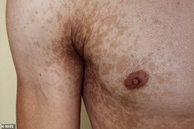 Pityriasis versicolor, also known as tinea versicolor is a common fungal skin infection
