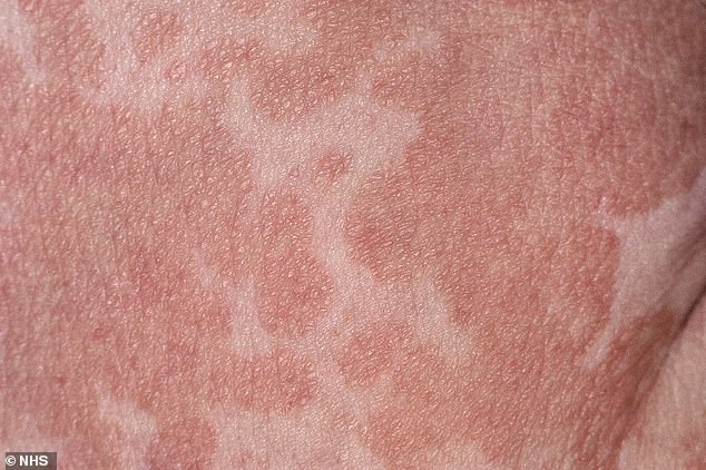 With most people carrying this fungus on their skin without it causing problems, it can something grow and spread more than usual. It¿s not always clear why this happens